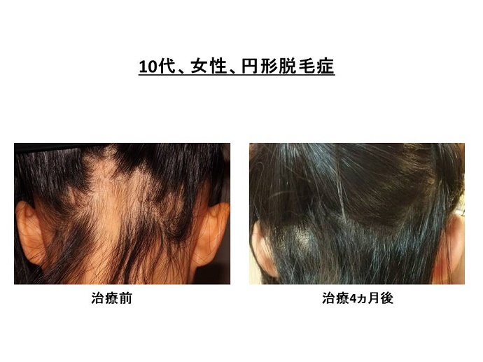 円形脱毛症　病院""
